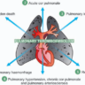 Pulmonary embolism