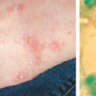 Scabies