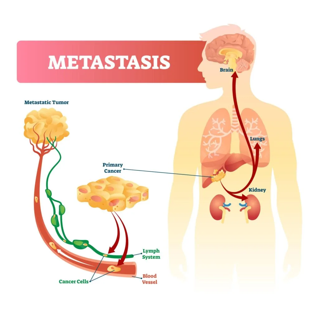 metastasis
Metastasis is responsible for most serious cancer complications.