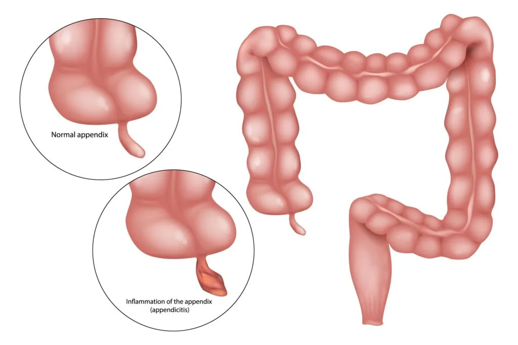 Appendicitis Medical Illustration of Human Colon. Human Large Intestine Anatomy with Normal and Inflamed Appendix