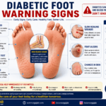 Medical illustration showing diabetic foot warning signs including numbness, tingling, burning feet, slow-healing wounds, swelling, and foot ulcers.