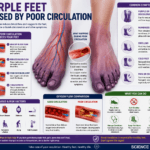 Medical illustration of purple feet caused by poor circulation, showing blood vessels, reduced oxygen flow, and symptoms such as numbness, swelling, and cold feet.