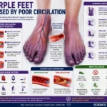 Medical illustration of purple feet caused by poor circulation, showing blood vessels, reduced oxygen flow, and symptoms such as numbness, swelling, and cold feet.